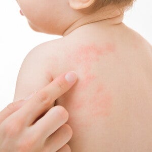 Bubite pe corp la copii